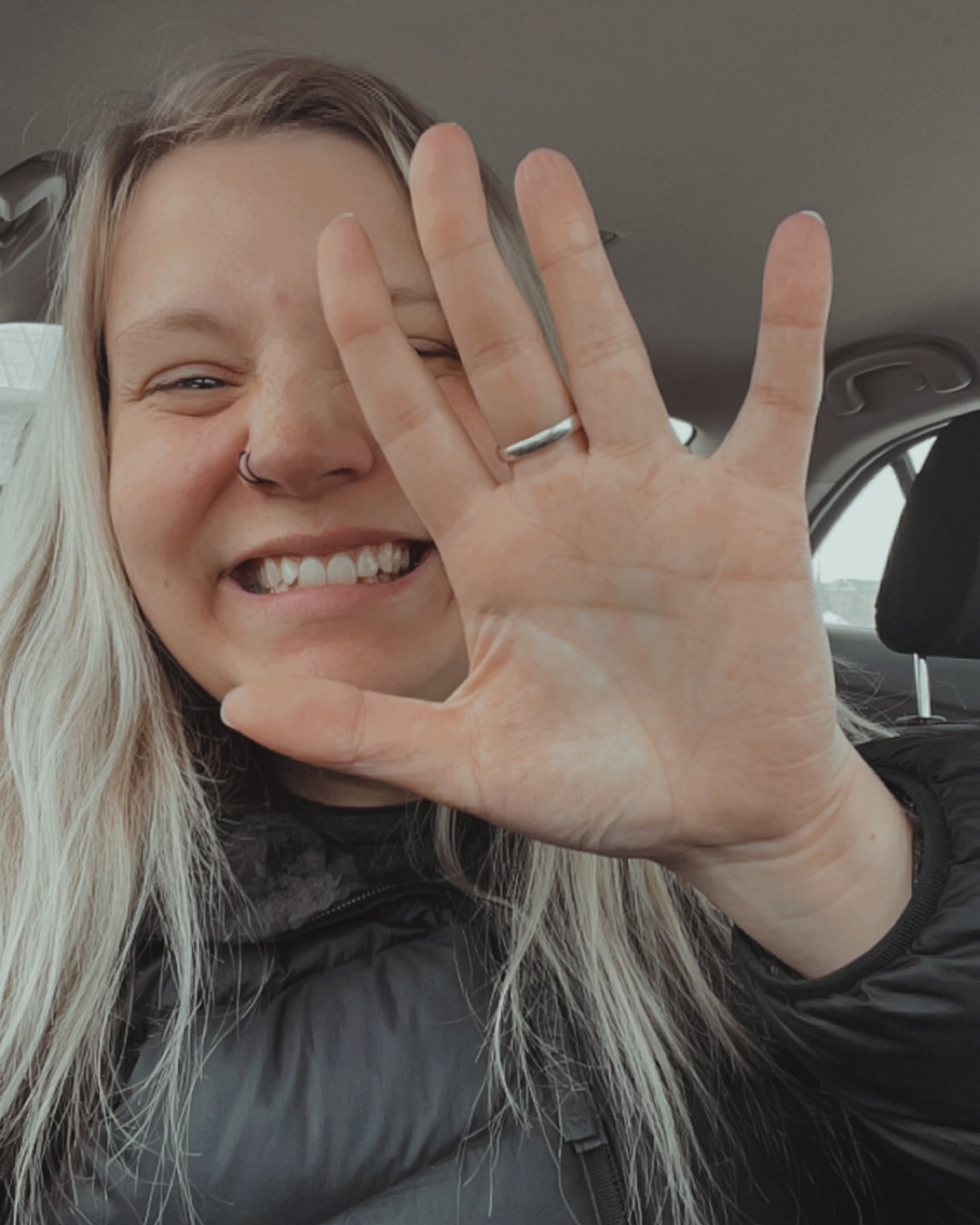 girl after hyperhidrosis
